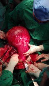 fibroma gigante