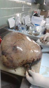 fibroma gigante