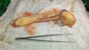 tumor cardíaco atípico