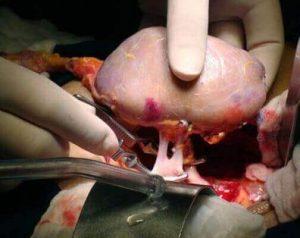 primer trasplante renal de donante vivo