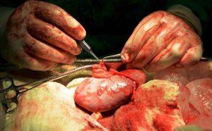 primer trasplante renal de donante vivo