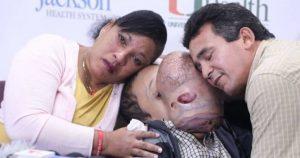 tumor facial