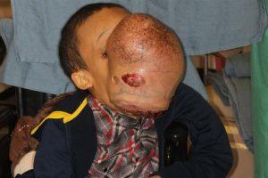 tumor facial
