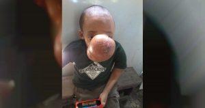 tumor facial
