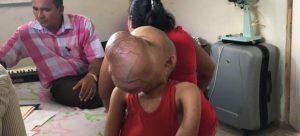 tumor facial