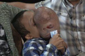 tumor facial